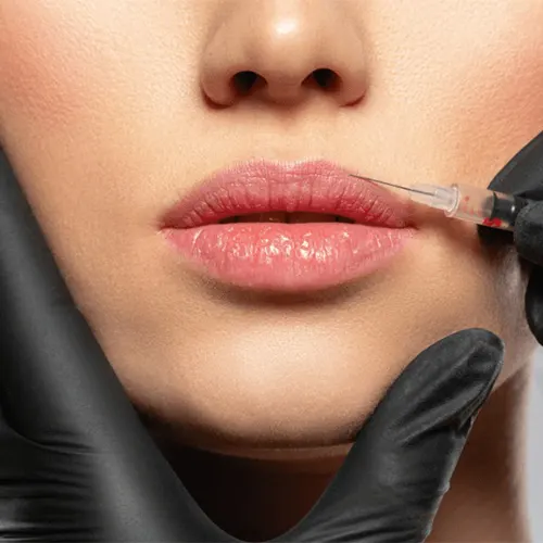 Lip Fillers
